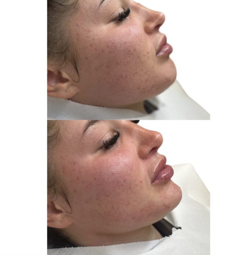 chin filler