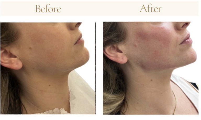 jaw filler