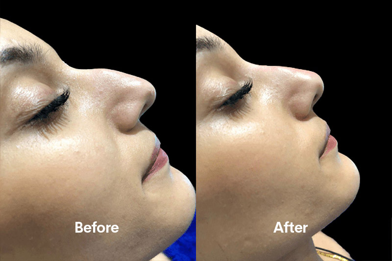 non surgical rhinoplasty